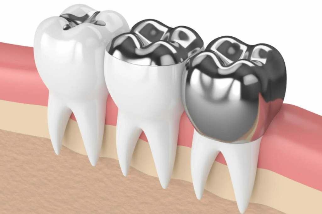 Best Dental Fillings in Delhi