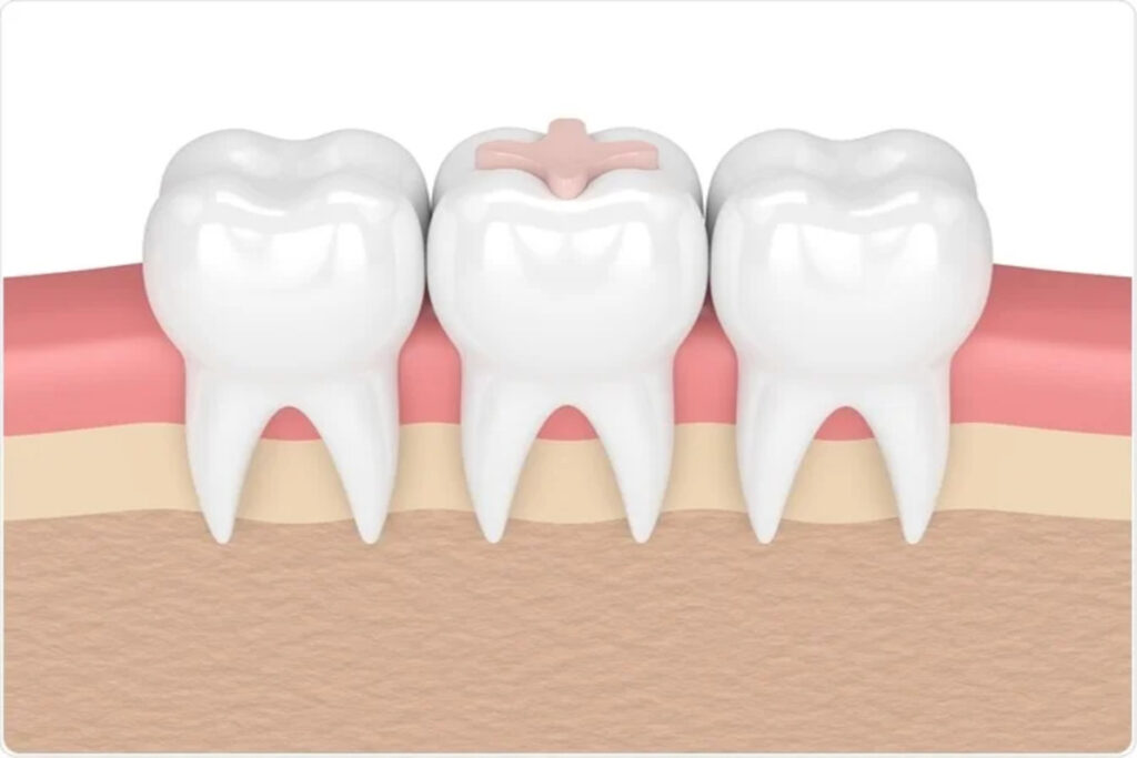 Dental Fillings Treatment in Delhi