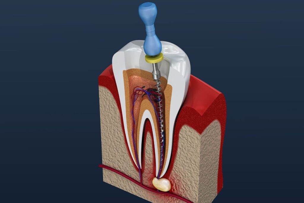 Root Canal Treatment Cost in India