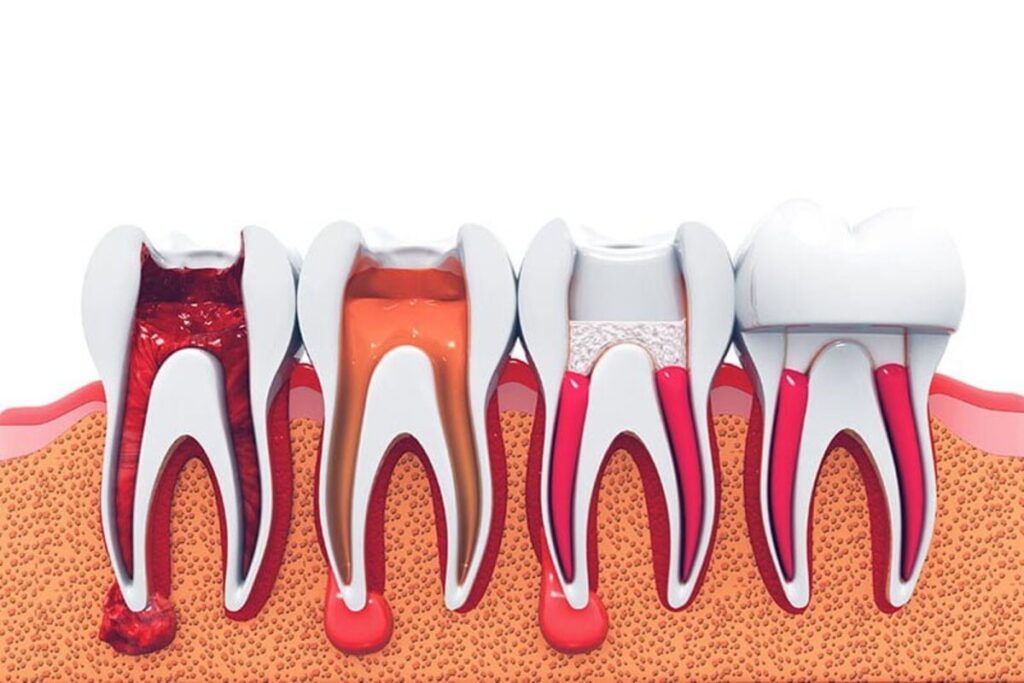 Root Canal Treatment in India